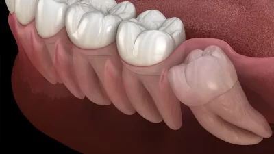 Yirmilik Diş Nedir? Yirmilik dişler, ağzın en arkasında bulunan üçüncü