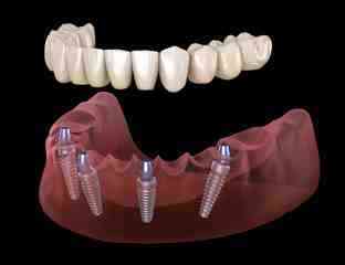 Diş Hekimi Umut Çelepkolu Anlatıyor Dişsizlik, sadece estetik bir problem