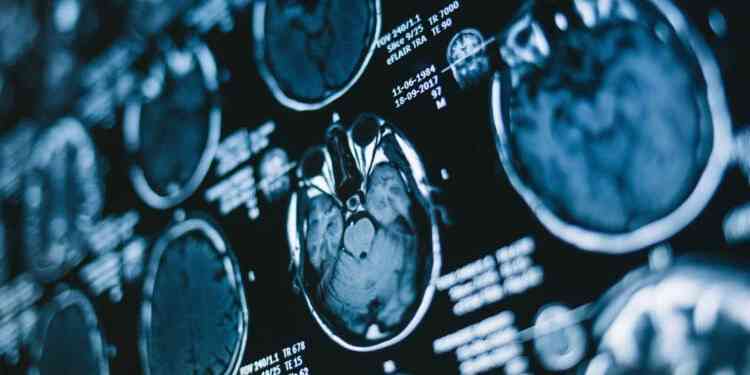 Pandemi Beyin Sağlığını da Etkilediİngiltere’de yapılan yeni bir bilimsel araştırma,