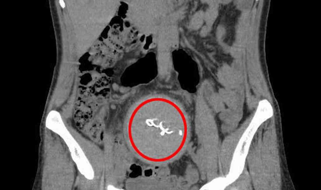 Antalya’da, 2021 yılında özel bir hastanede sezaryenle doğum yapan Y.S.