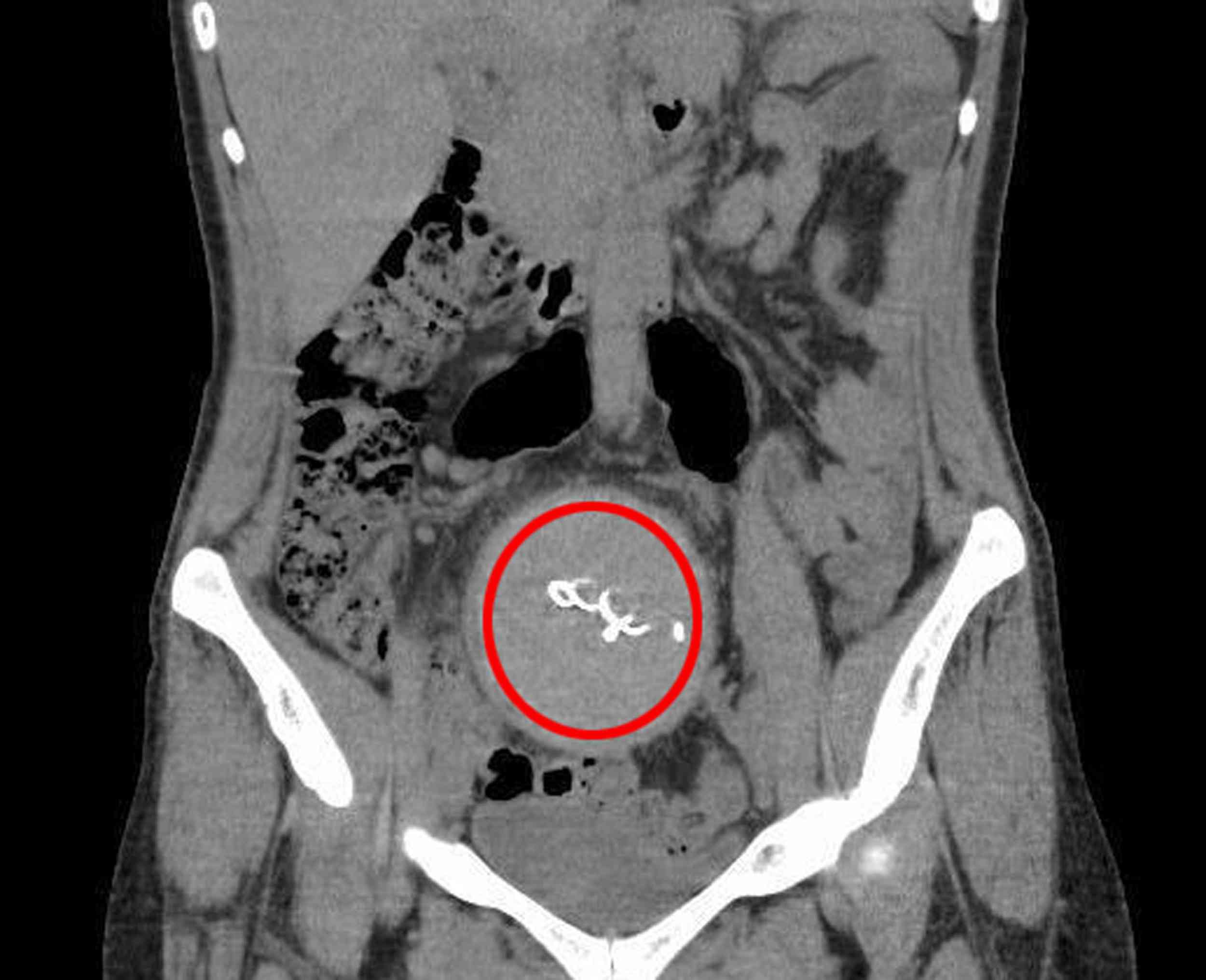 Antalya’da, 2021 yılında özel bir hastanede sezaryenle doğum yapan Y.S.