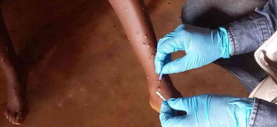 Mpox Vaka Sayısı ArtıştaBatı Afrika ülkesi Gana, M-çiçeği (mpox) virüsünde