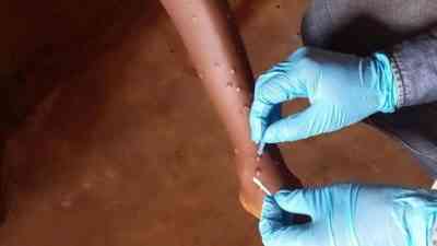 Mpox Vaka Sayısı ArtıştaBatı Afrika ülkesi Gana, M-çiçeği (mpox) virüsünde
