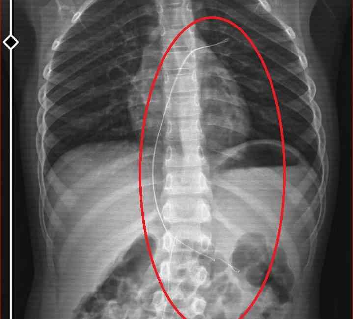 Şırnak’ta, 6 yaşındaki Aram Devran Ötün’ün, 3 yıl önceki tedavi