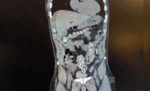 Fas’tan Türkiye’ye midesinde uyuşturucu kapsülleriyle gelen 52 yaşındaki Cüneyt Ç.,