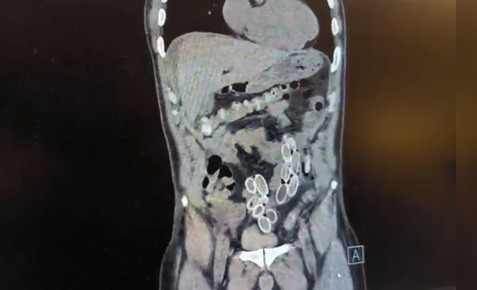 Fas’tan Türkiye’ye midesinde uyuşturucu kapsülleriyle gelen 52 yaşındaki Cüneyt Ç.,