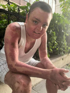 &nbsp; Kuaförde Yangın: Çocuk Üçüncü Derece Yanıkla Hastaneye Kaldırıldı Kağıthane